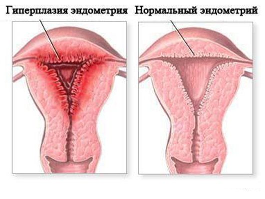 giperplaziya-endometriya-matki-1425107