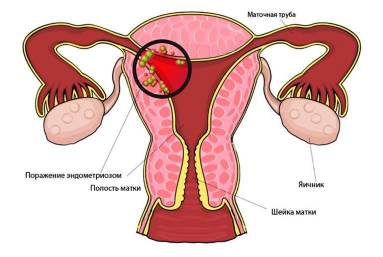 section-of-female-reproductive-system-and-germs-on-different-parts