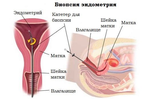 kak-vypolnyayut-biopsiyu-endometriya-4299009