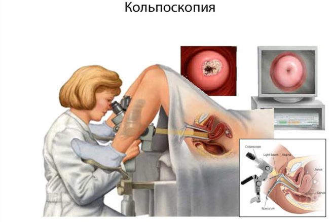 kolposkopiya-kak-metod-diagnostiki-4143353