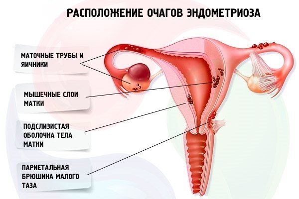 mesta-raspolozheniya-ochagovogo-endometrioza-3921851