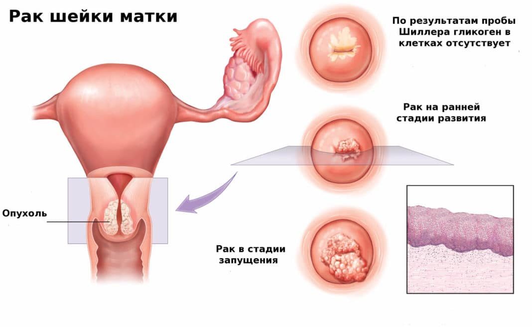 stadii-raka-shejki-matki-5611371