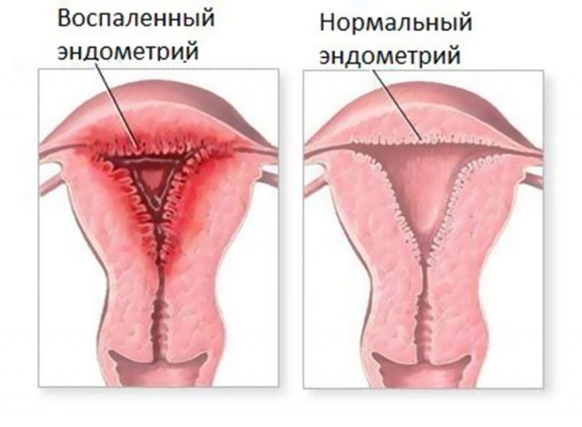 vyskablivanie-opasno-razvitiem-endometrita-4754990